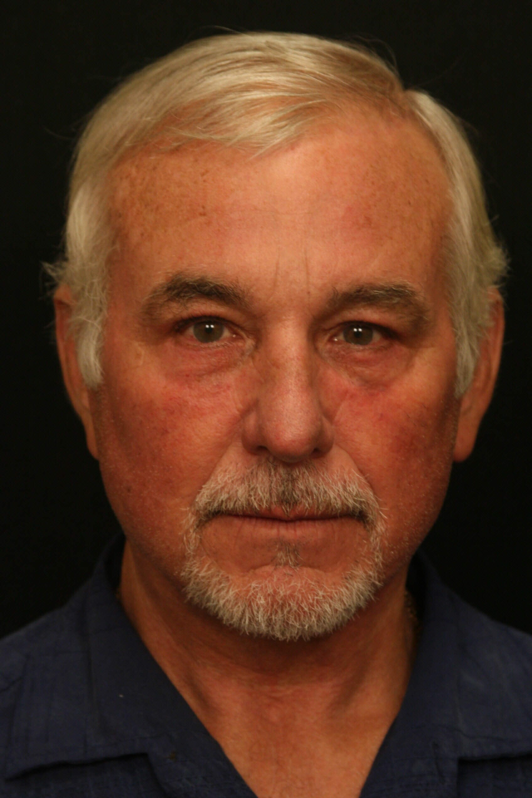 Facelift Before and After After