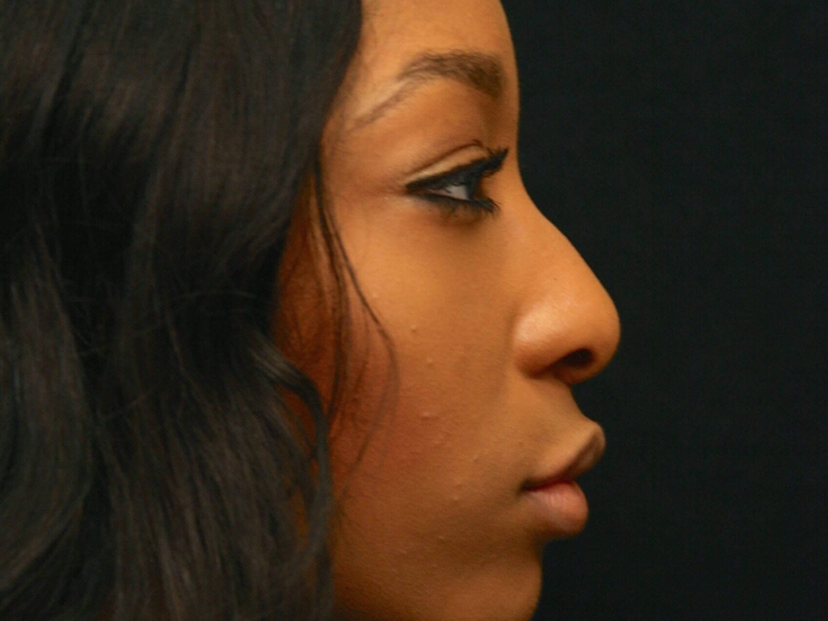 Before and After Rhinoplasty & Ethnic Rhinoplasty Photos