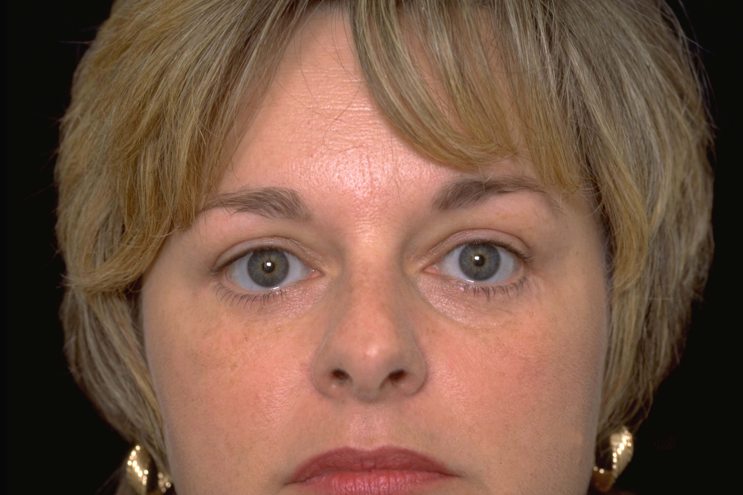 Upper and Lower Blepharoplasty After