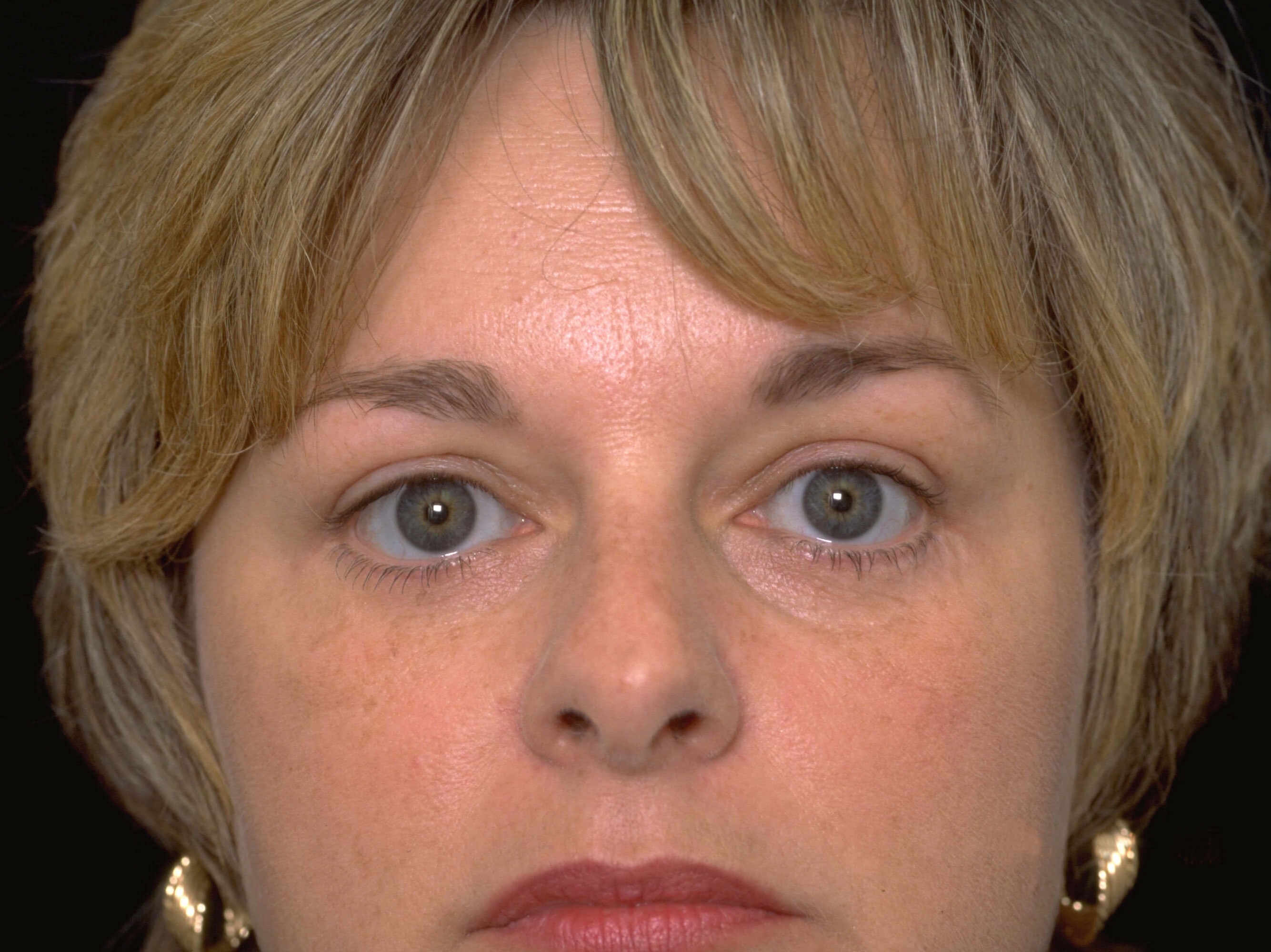 Upper and Lower Blepharoplasty After