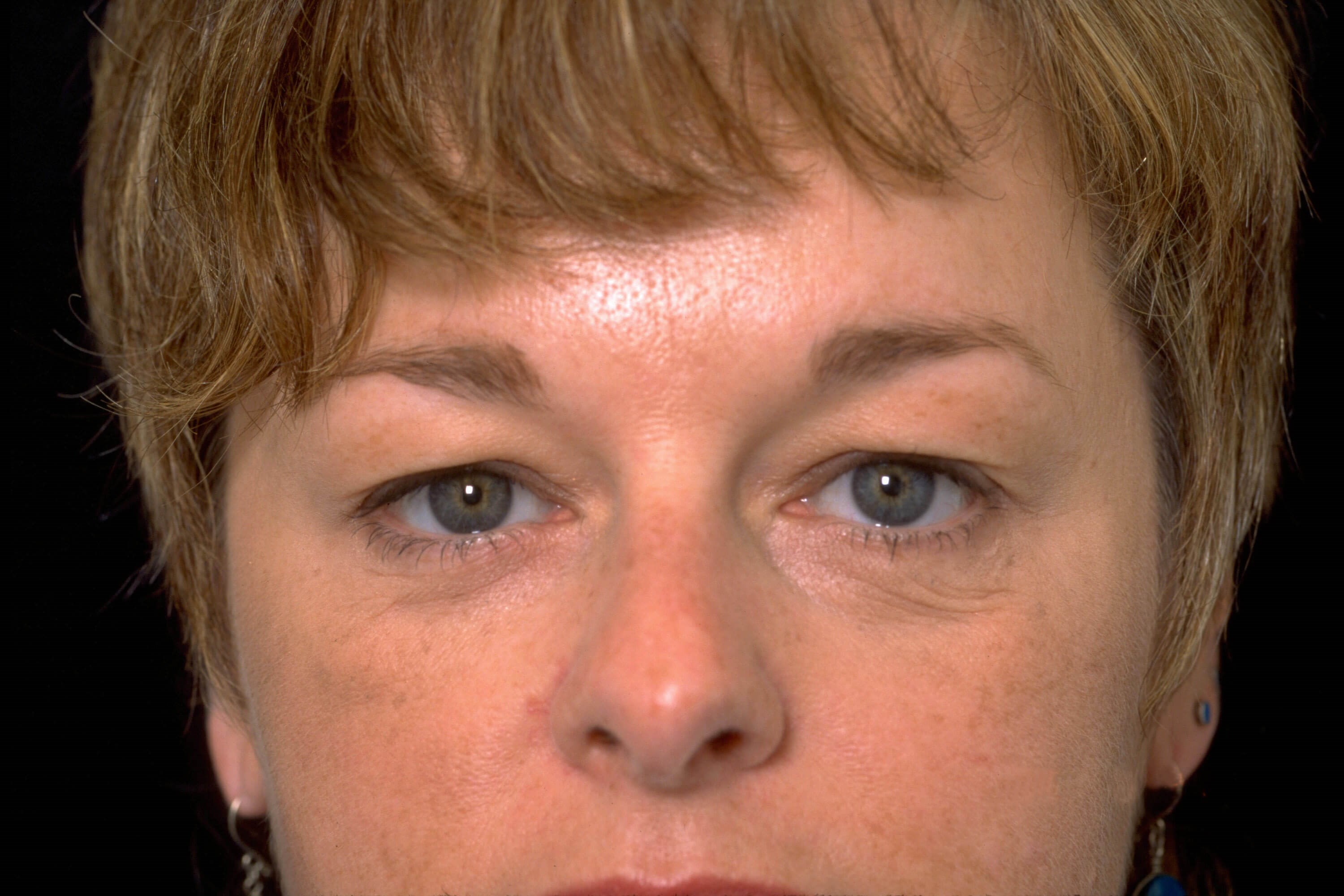 Upper and Lower Blepharoplasty Before