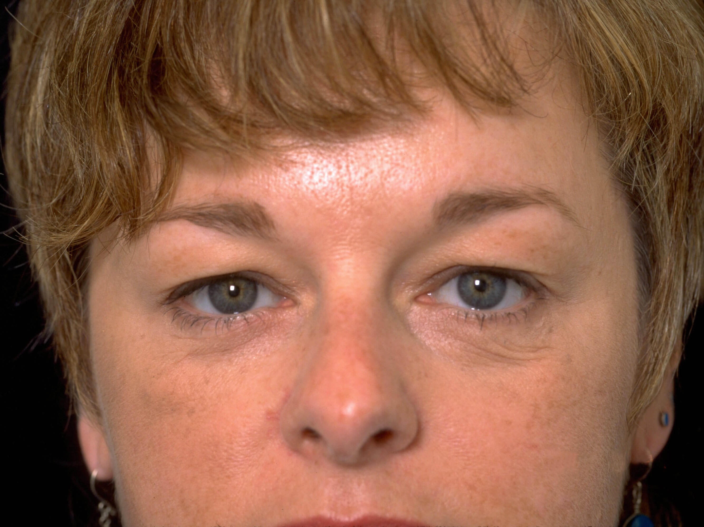 Upper and Lower Blepharoplasty Before