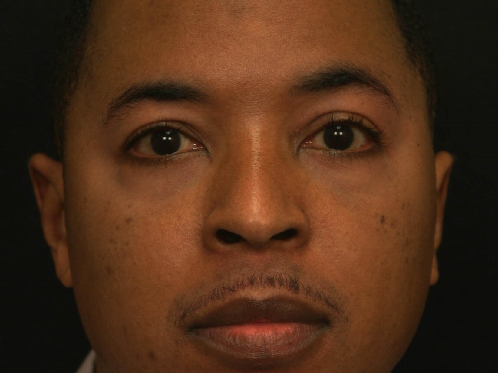 Lower Blepharoplasty After