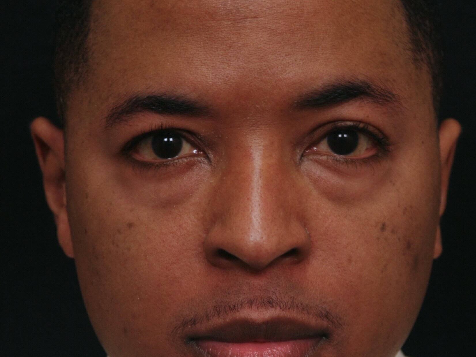 Lower Blepharoplasty Before