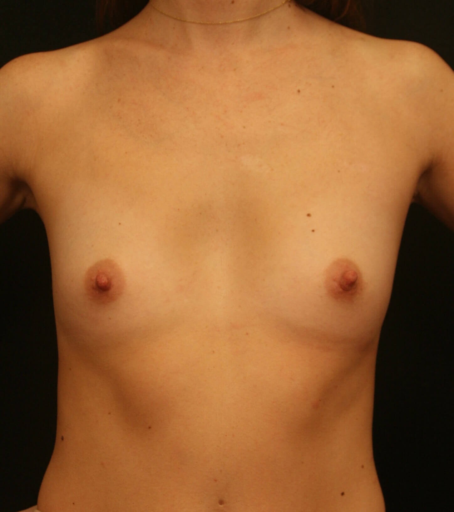 Breast Augmentation Results Before