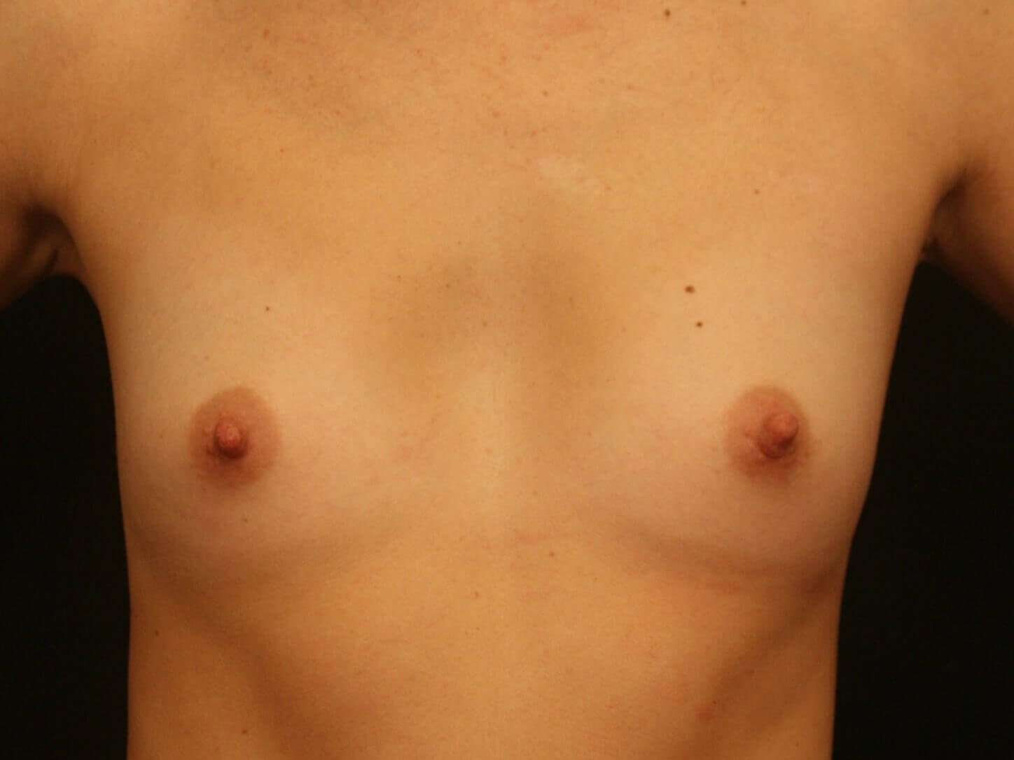 Breast Augmentation Results Before