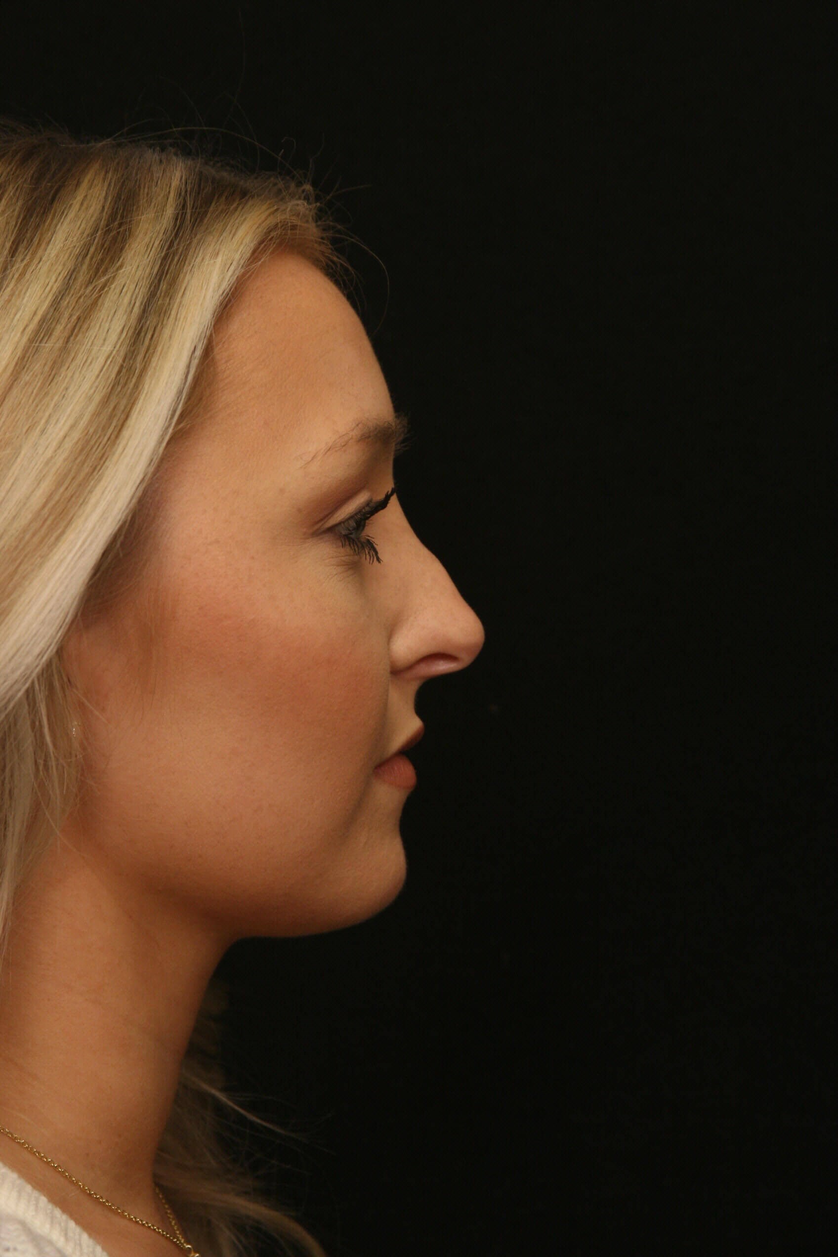 Rhinoplasty Before and After Before