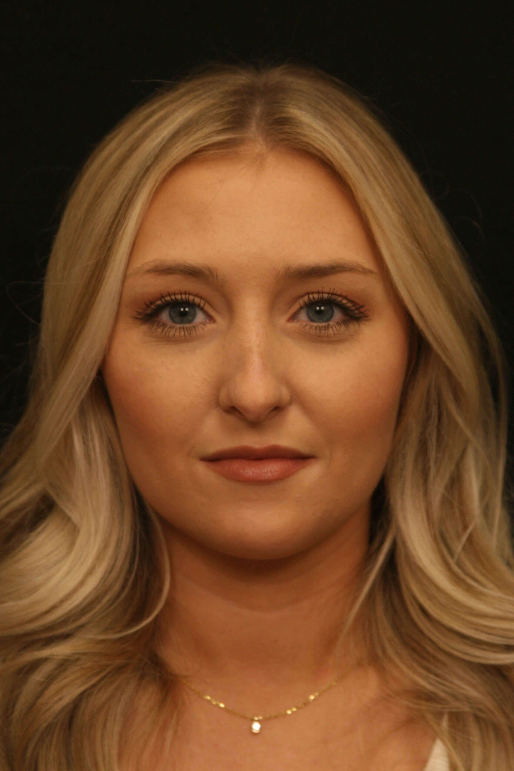 Rhinoplasty Before and After Before