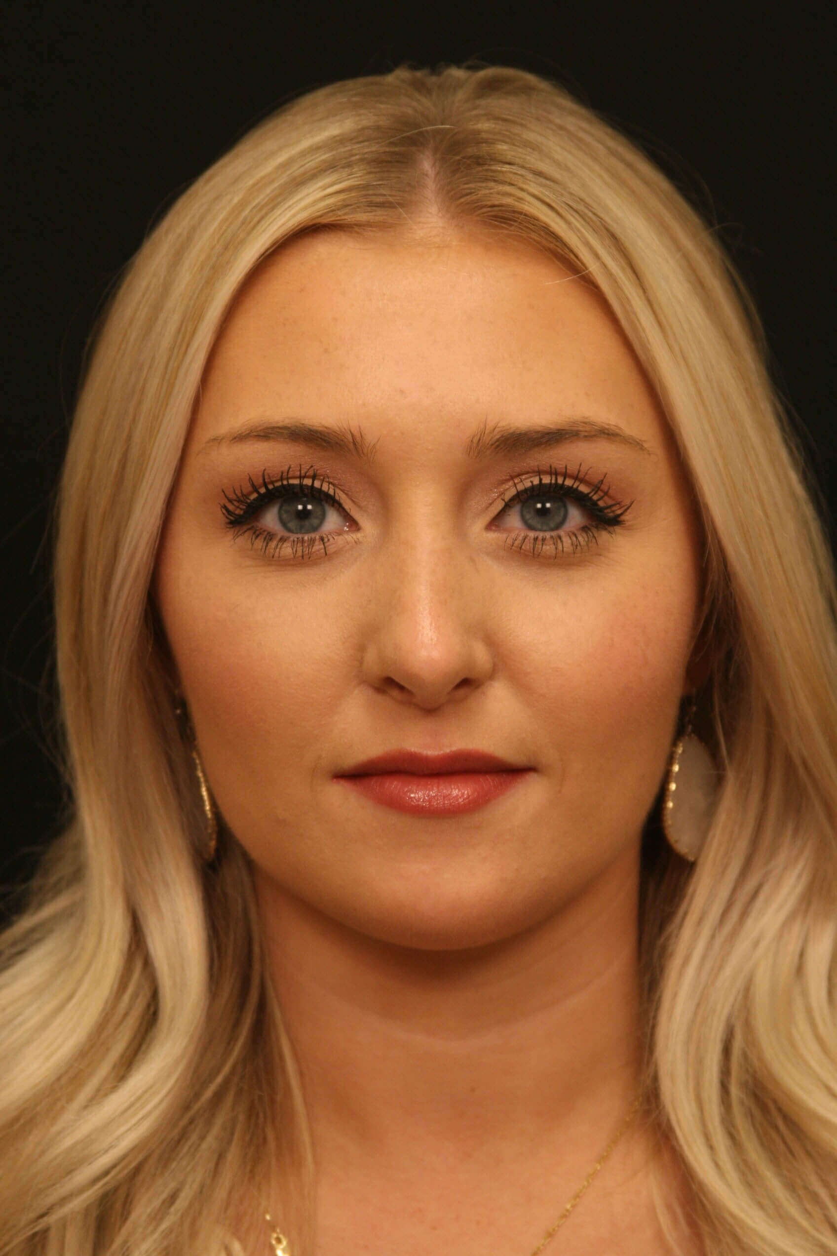 Rhinoplasty Before and After After