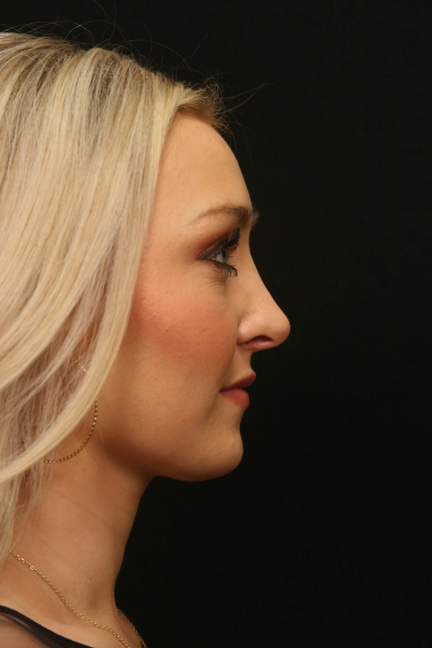 Rhinoplasty Before and After After