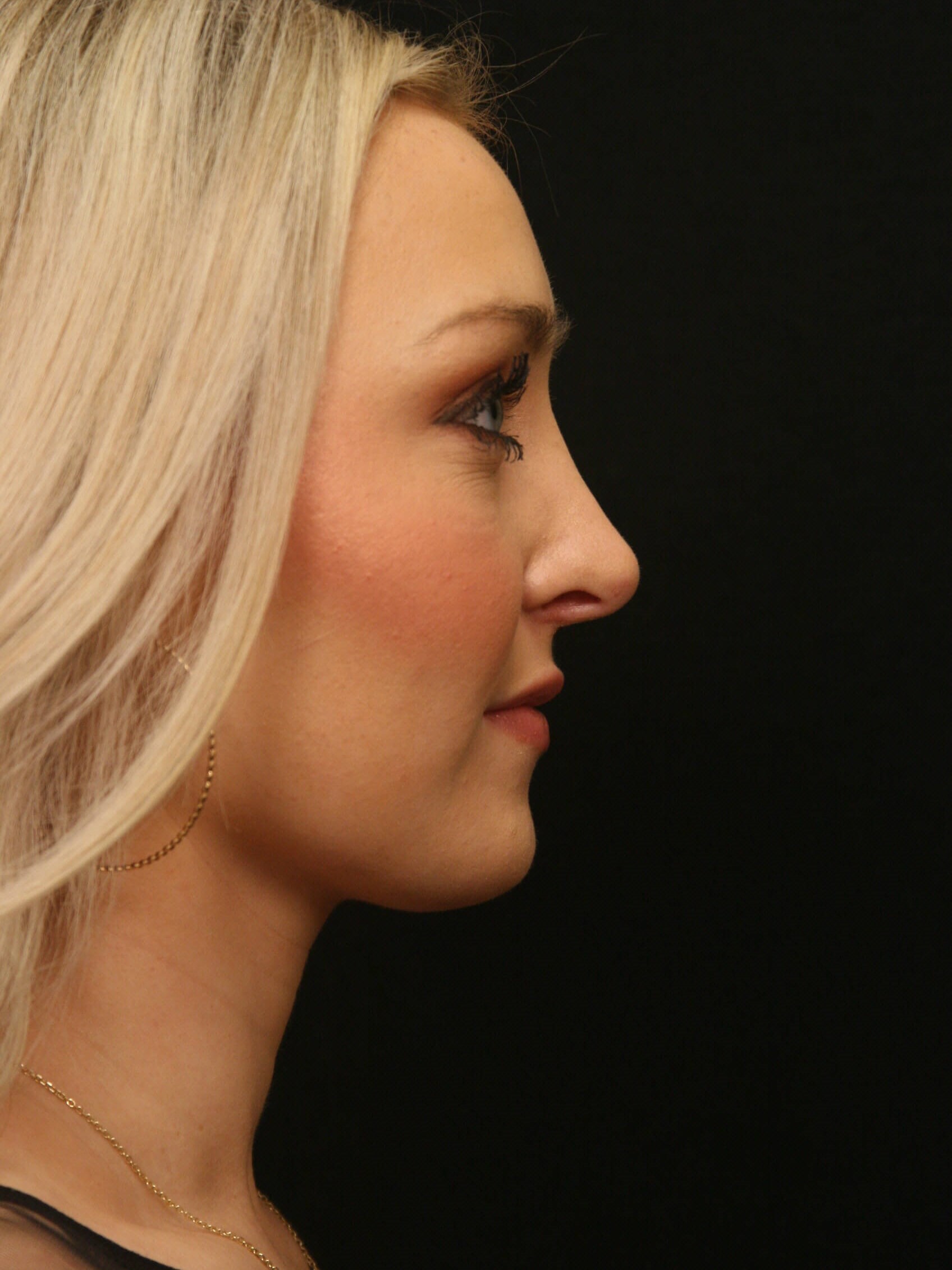 Rhinoplasty Before and After After
