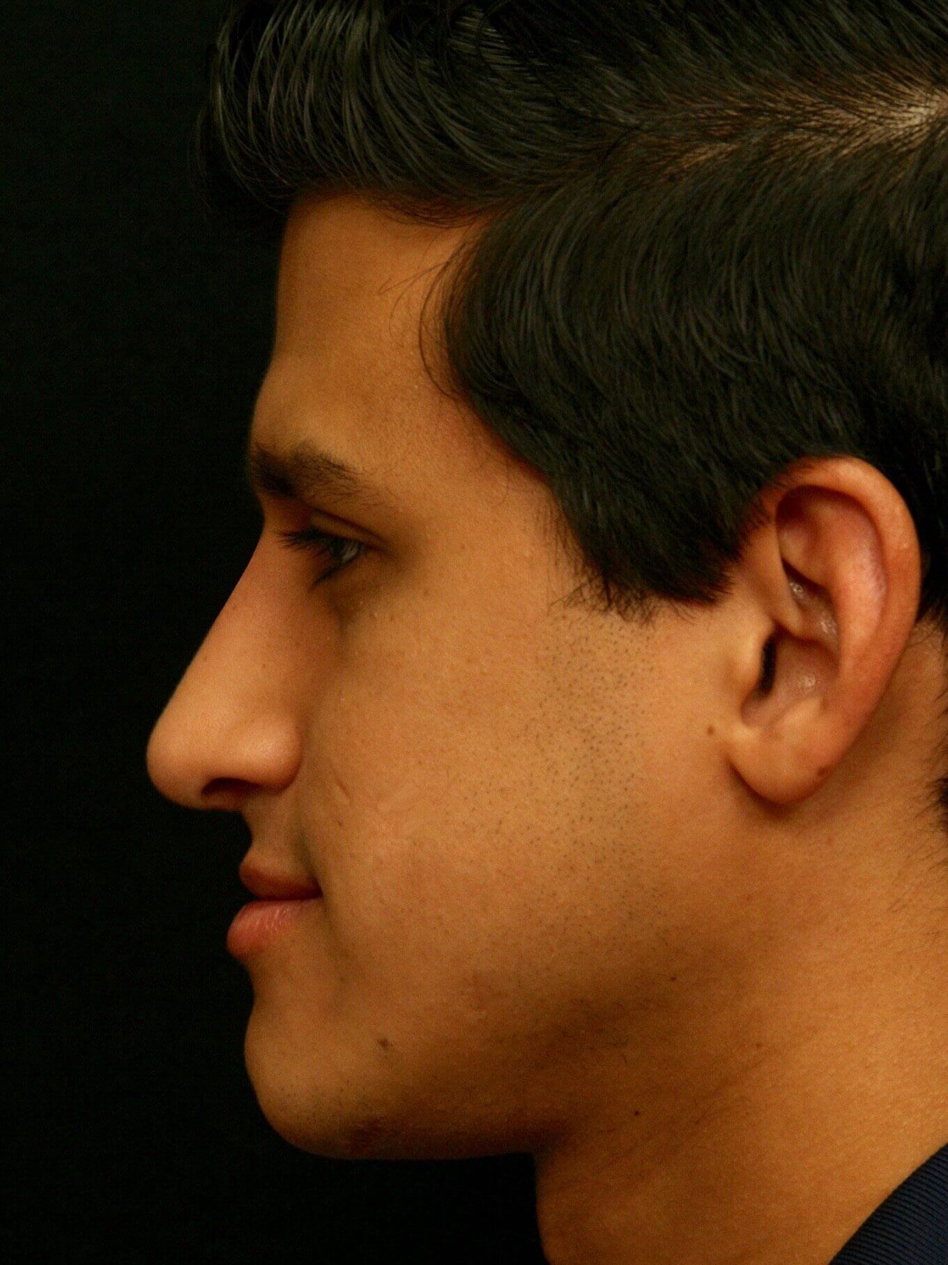 Rhinoplasty Before and After After