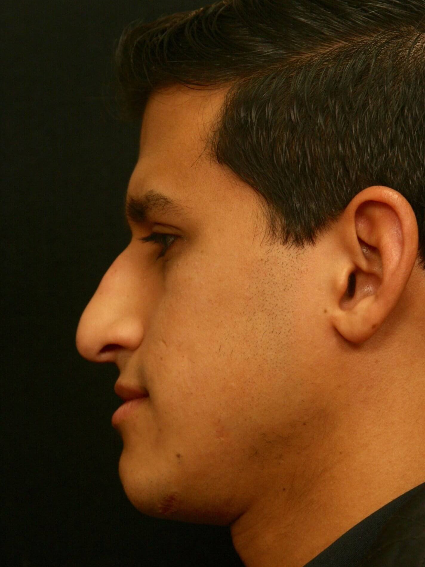 Rhinoplasty Before and After Before