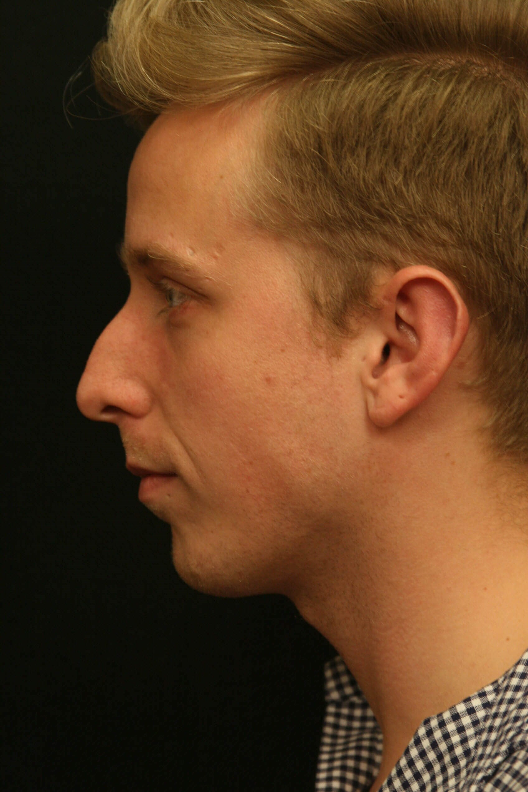 Rhinoplasty Before and After Before