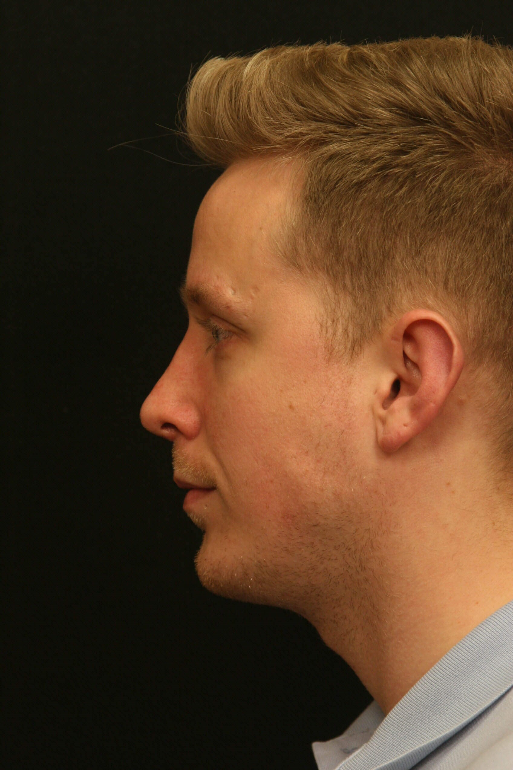 Rhinoplasty Before and After After