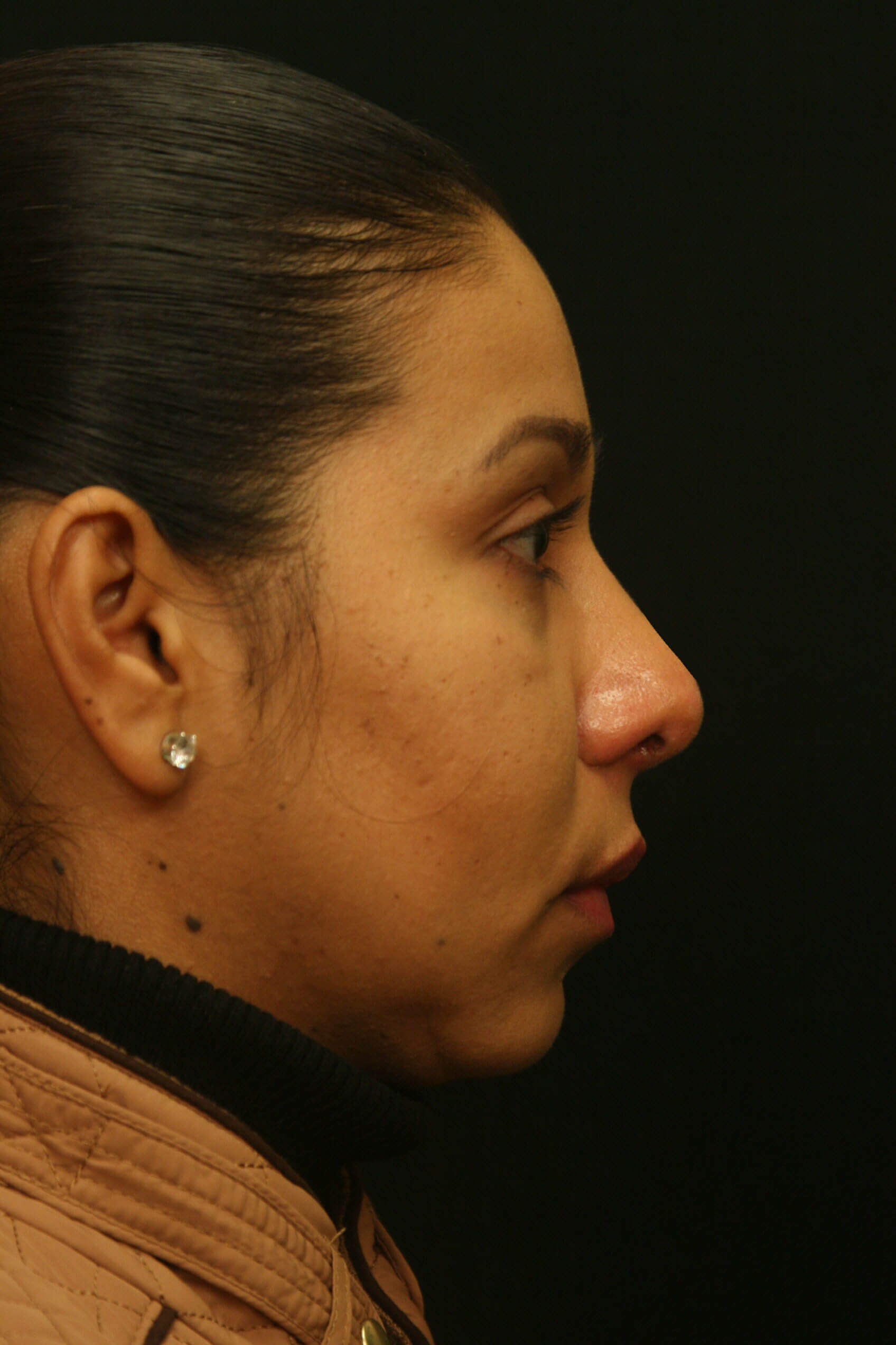 Rhinoplasty Before and After After