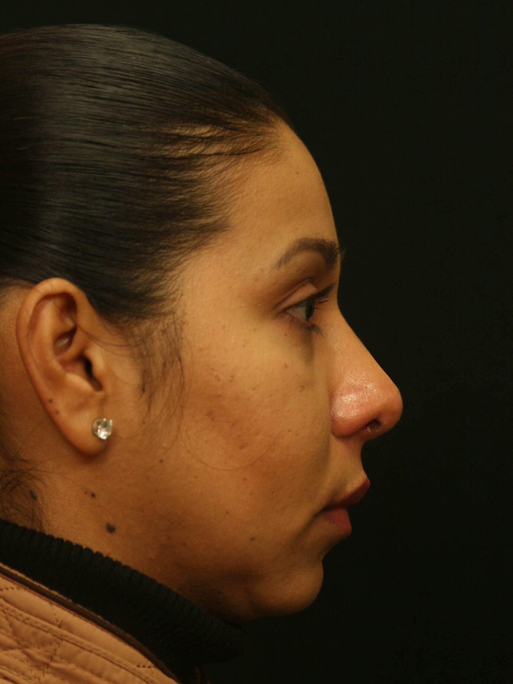 Rhinoplasty Before and After After