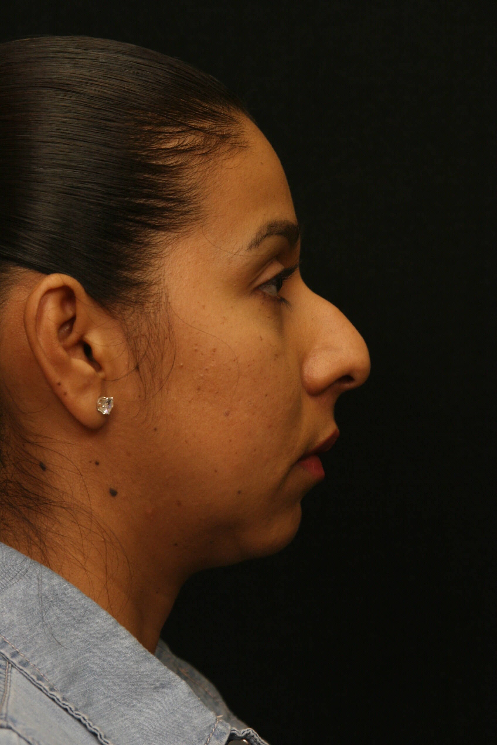 Rhinoplasty Before and After Before