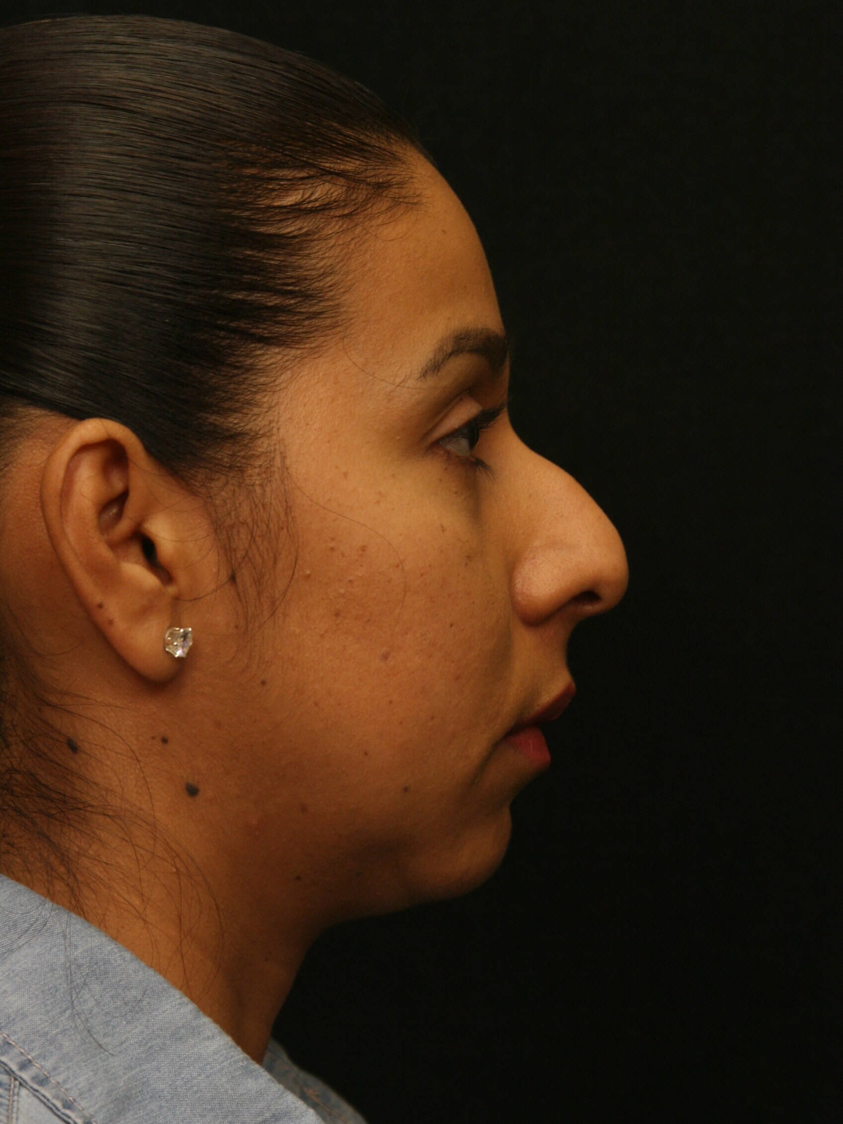 Rhinoplasty Before and After Before
