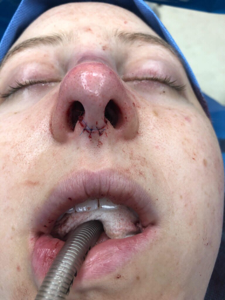 Rhinoplasty Before and After After