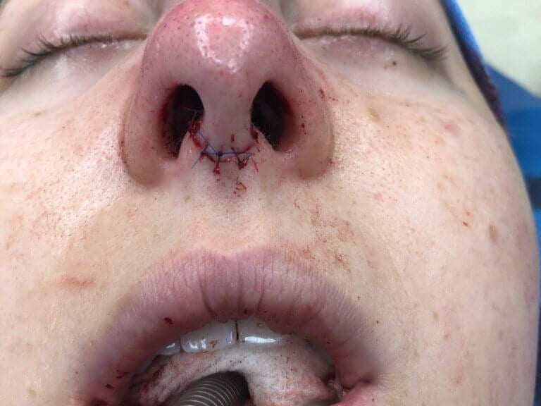 Rhinoplasty Before and After After