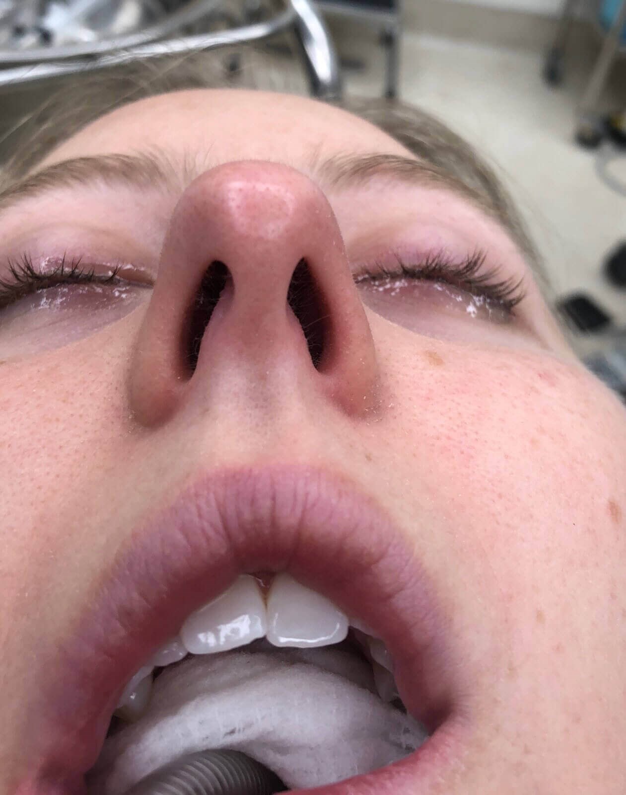 Rhinoplasty Before and After Before