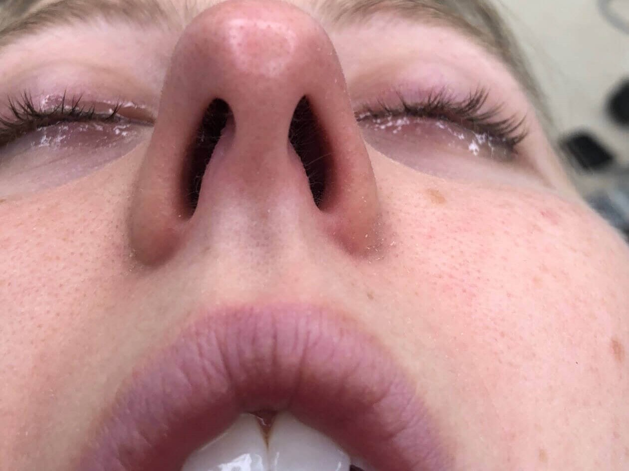 Rhinoplasty Before and After Before