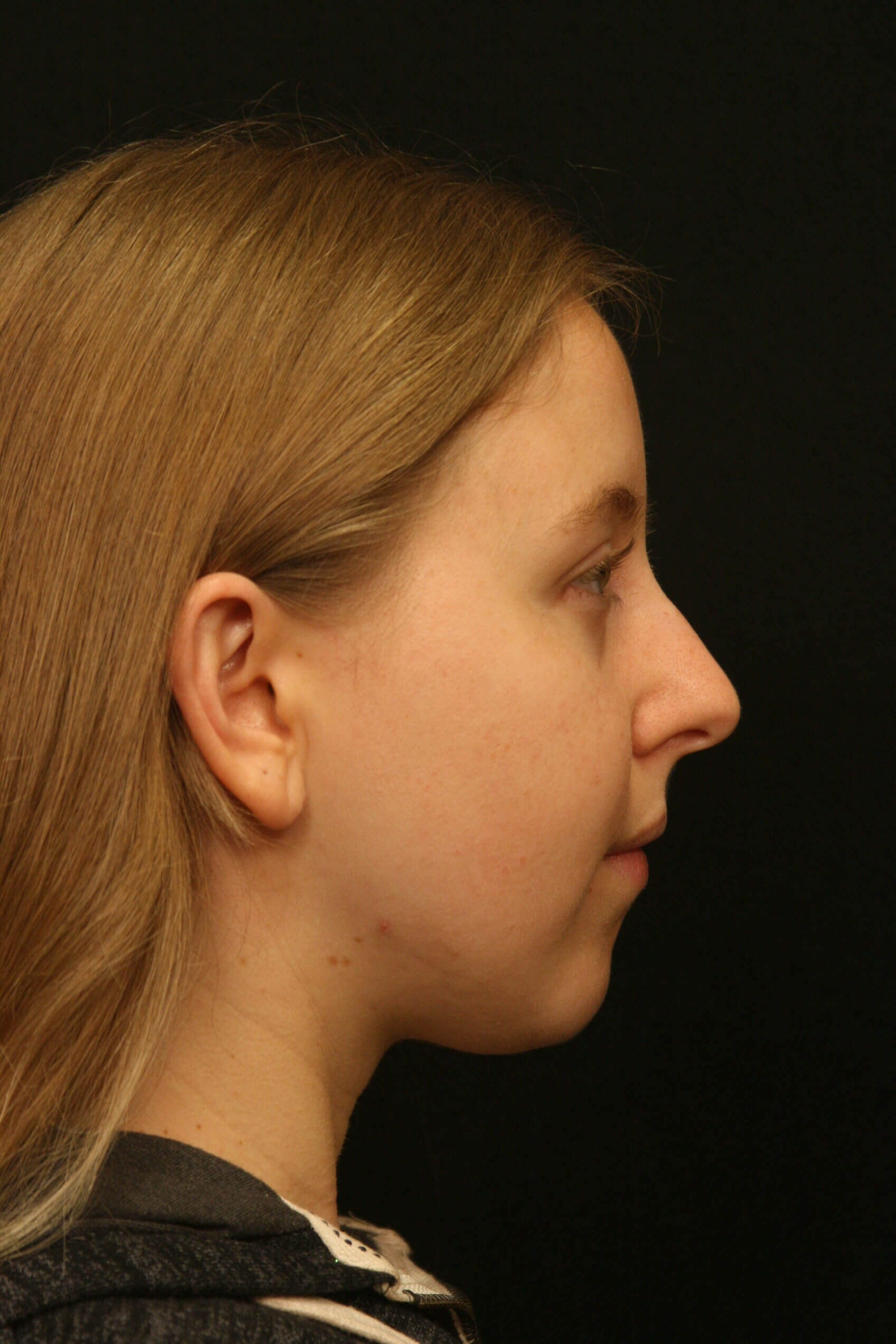 Rhinoplasty Before and After Before