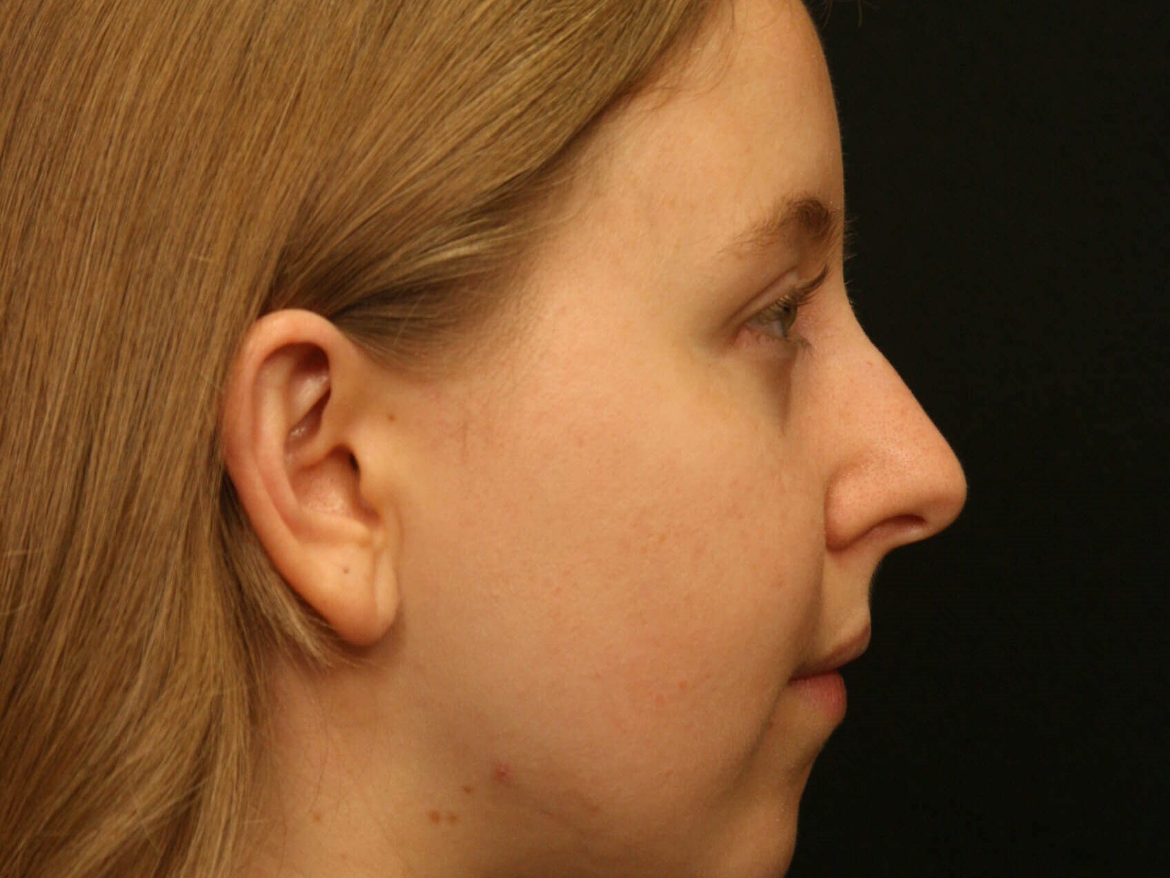 Rhinoplasty Before and After Before