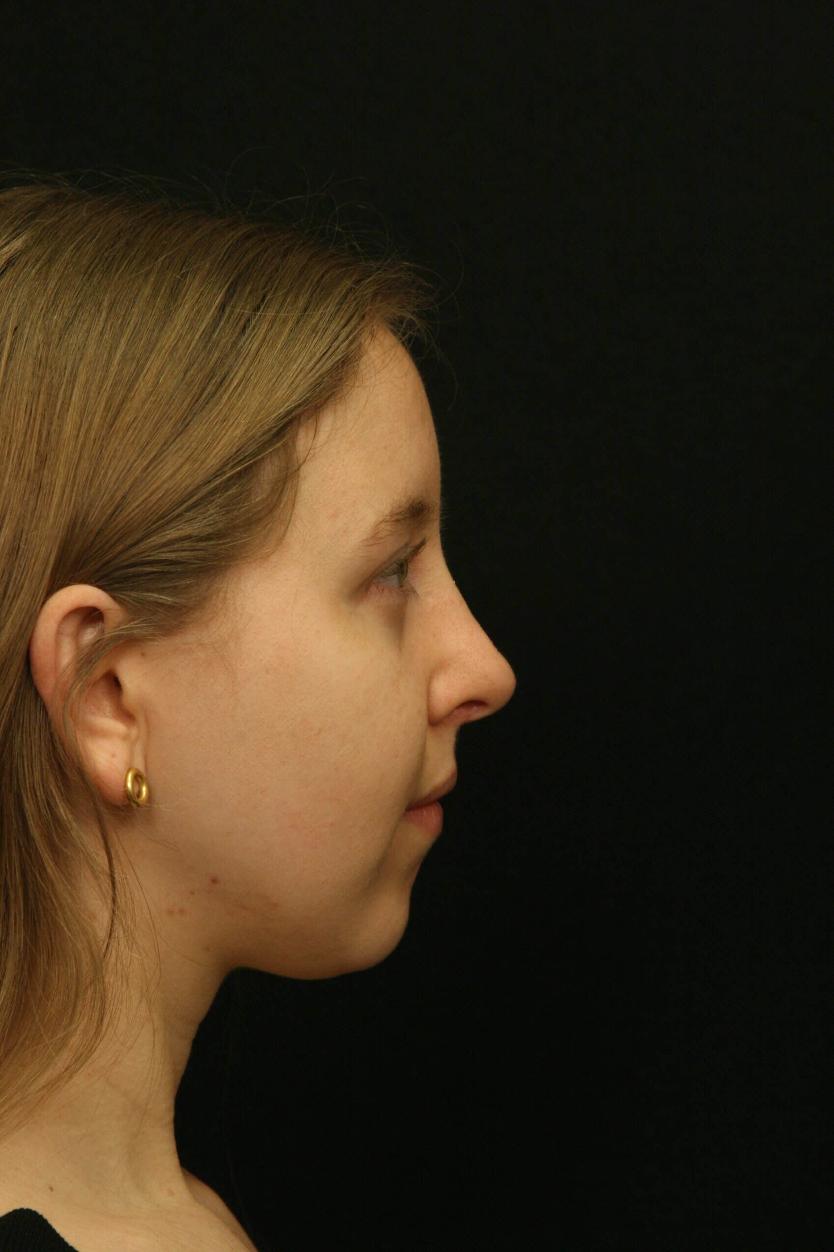 Rhinoplasty Before and After After