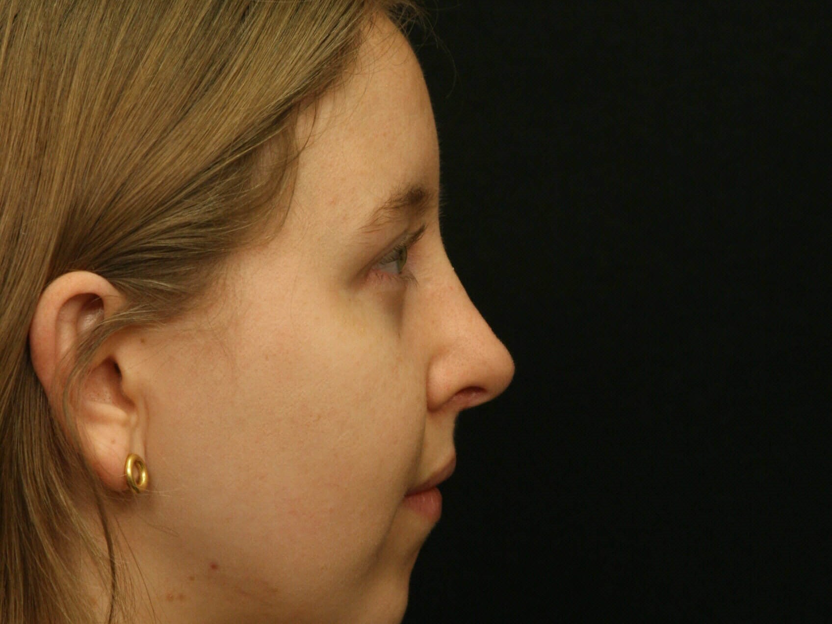 Rhinoplasty Before and After After