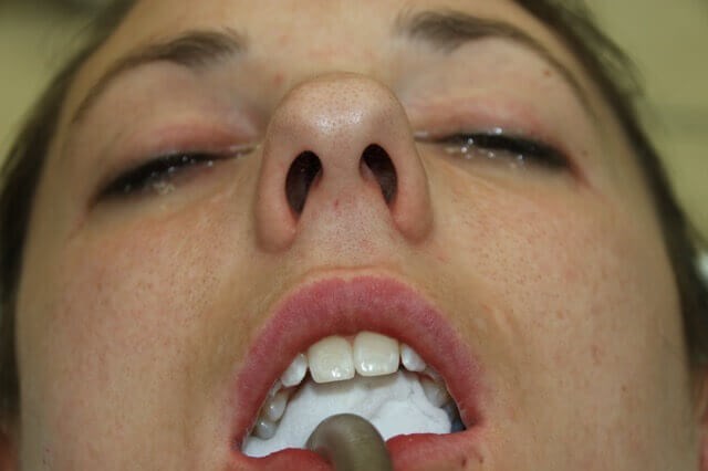 Rhinoplasty Before and After Before