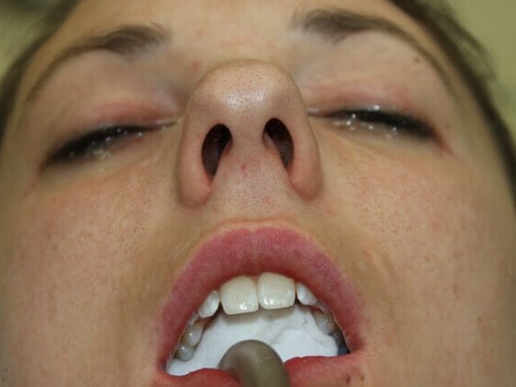 Rhinoplasty Before and After Before