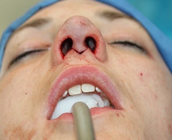 Rhinoplasty Before and After After