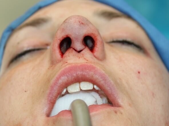 Rhinoplasty Before and After After