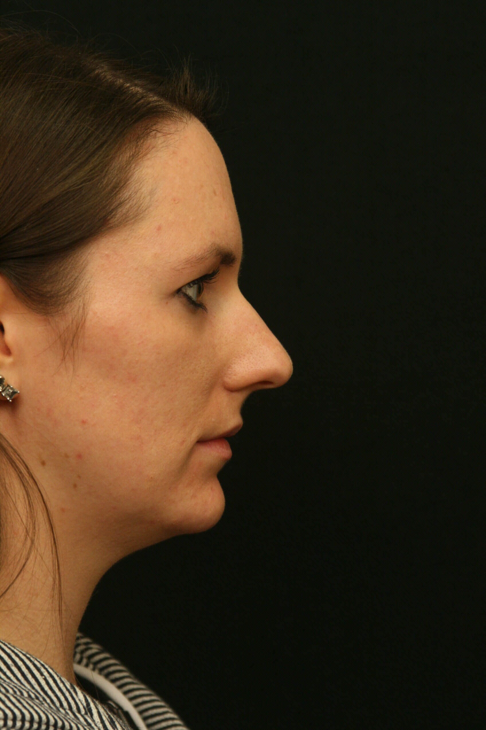 Rhinoplasty Before and After Before