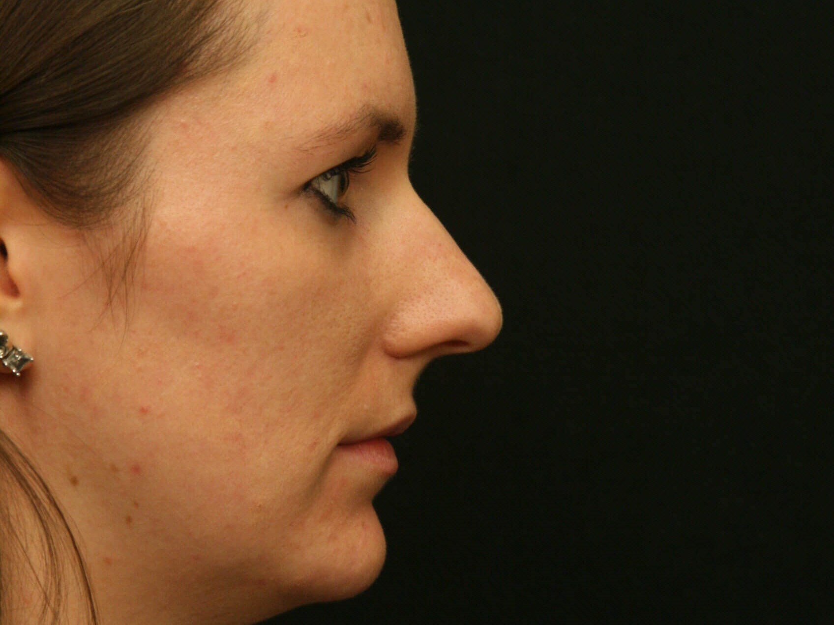 Rhinoplasty Before and After Before