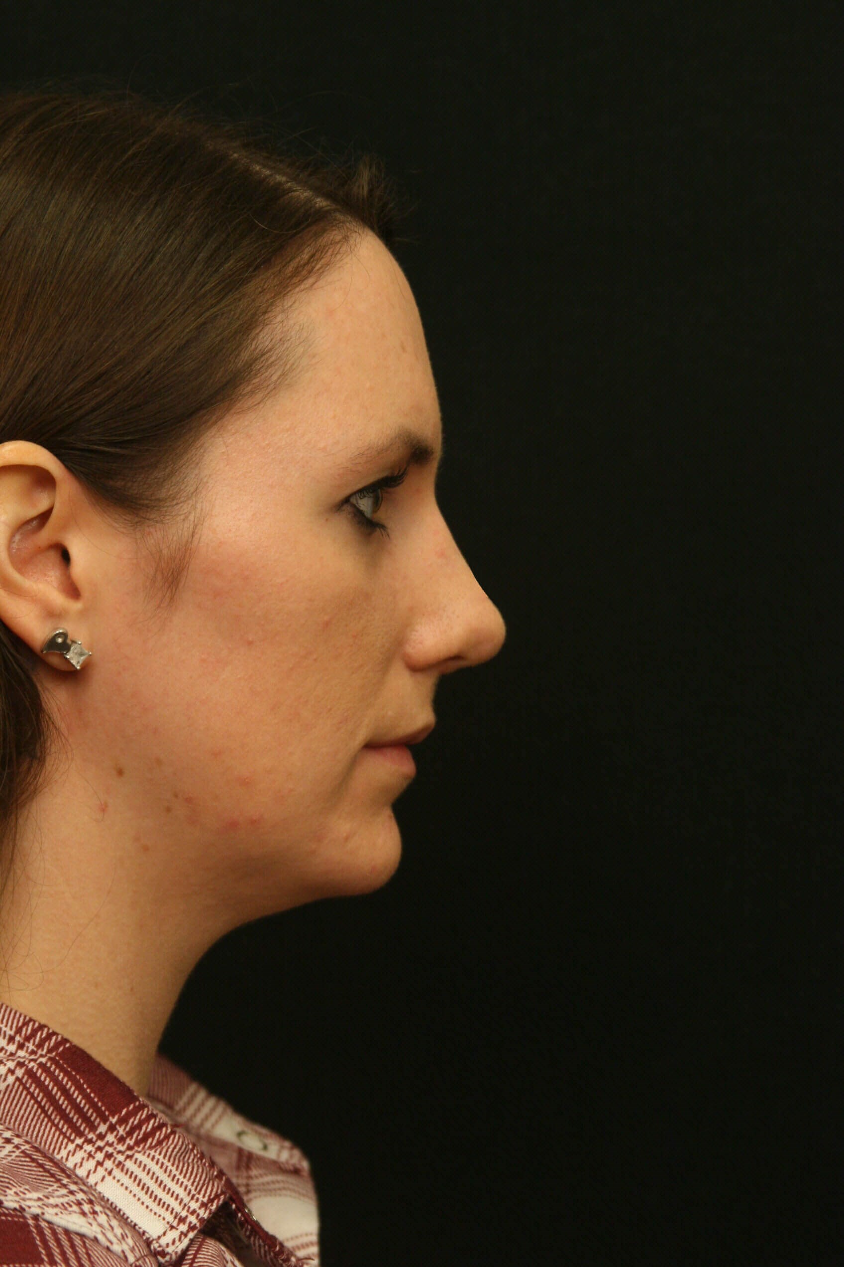 Rhinoplasty Before and After After