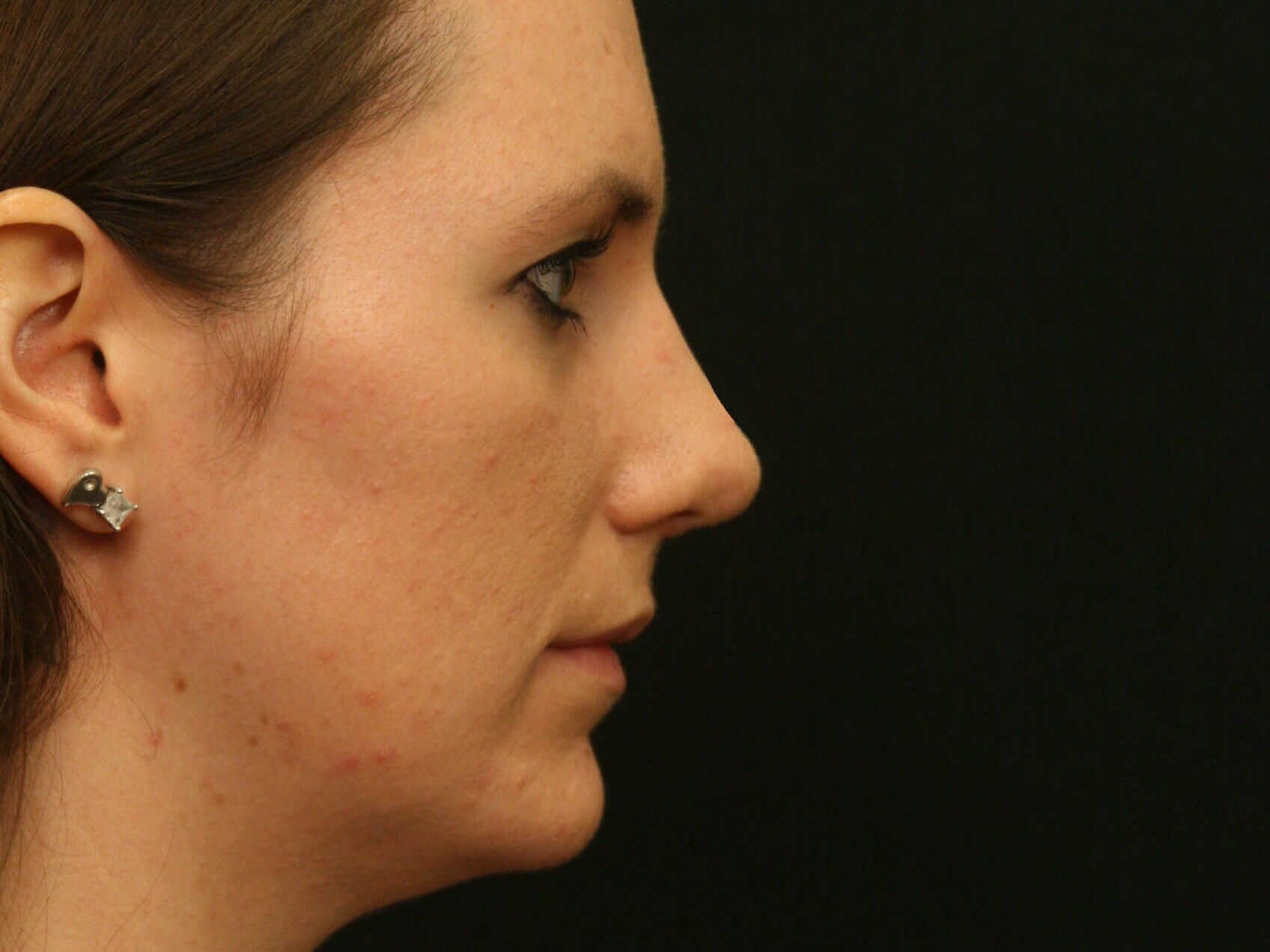 Rhinoplasty Before and After After