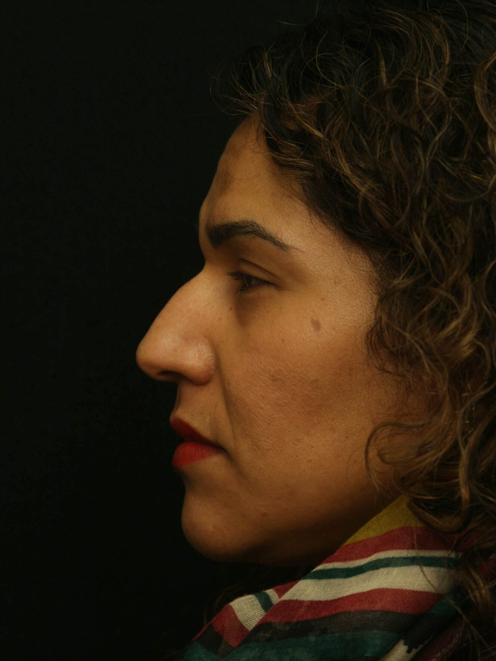 Rhinoplasty Before and After Before