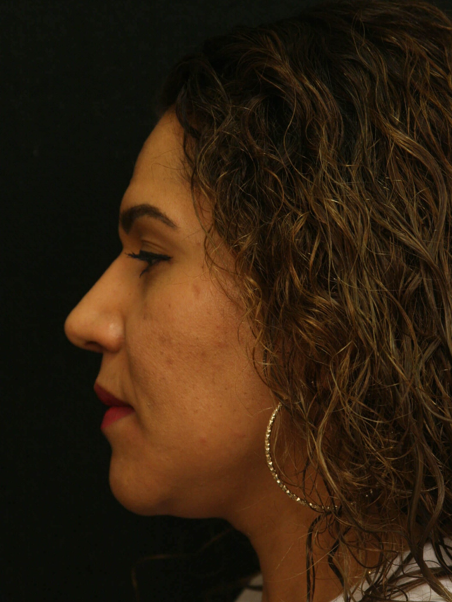 Rhinoplasty Before and After After