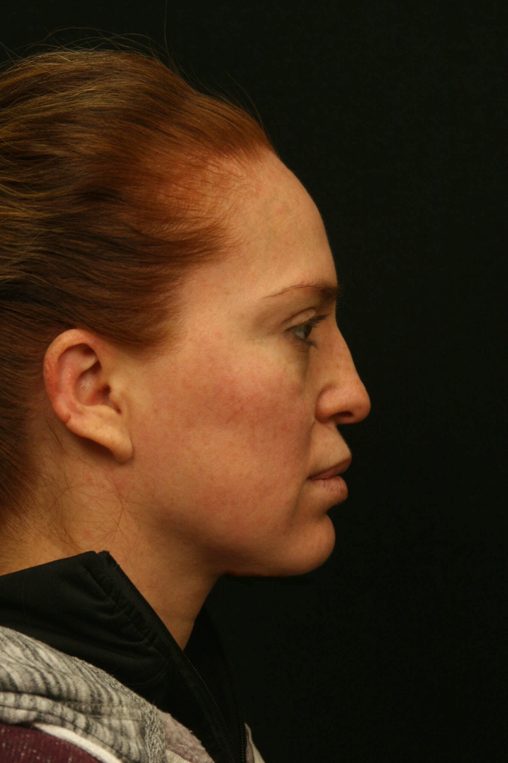 Rhinoplasty Before and After Before