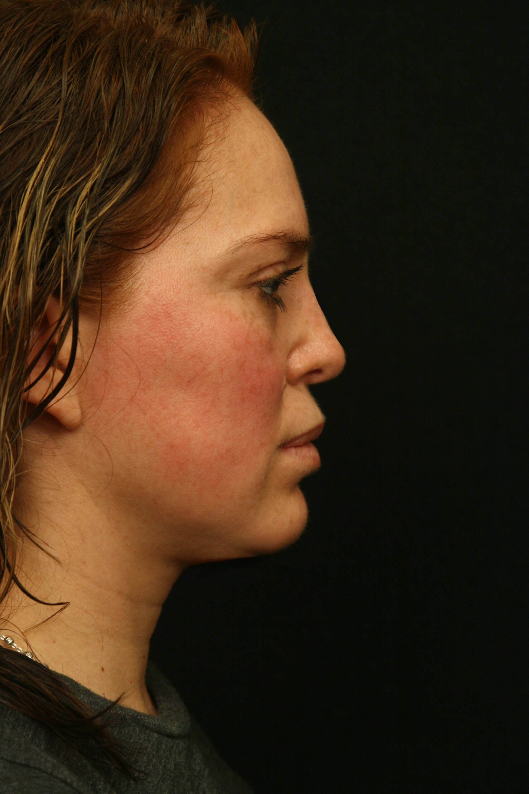 Rhinoplasty Before and After After