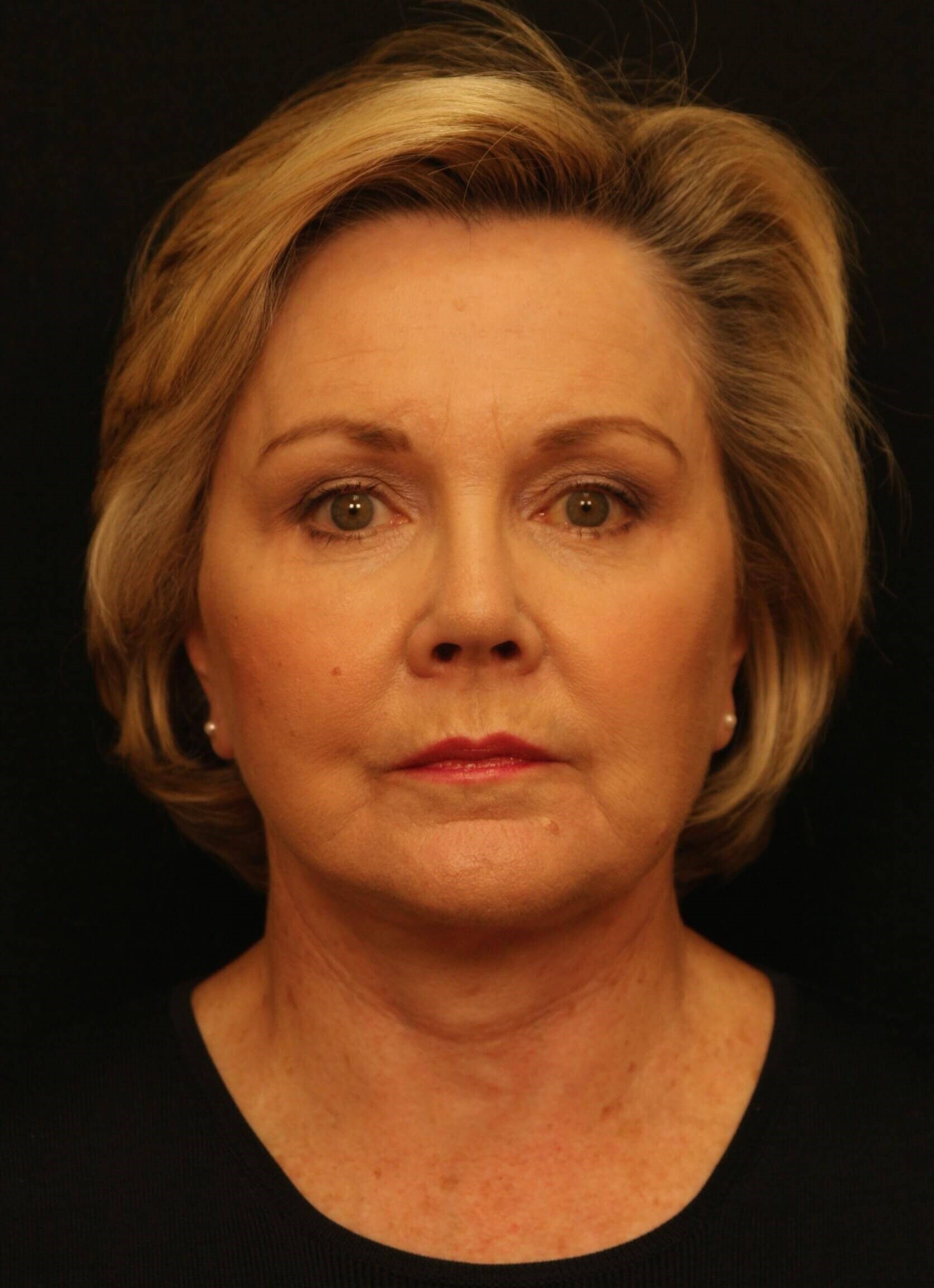 Facelift Before and After After