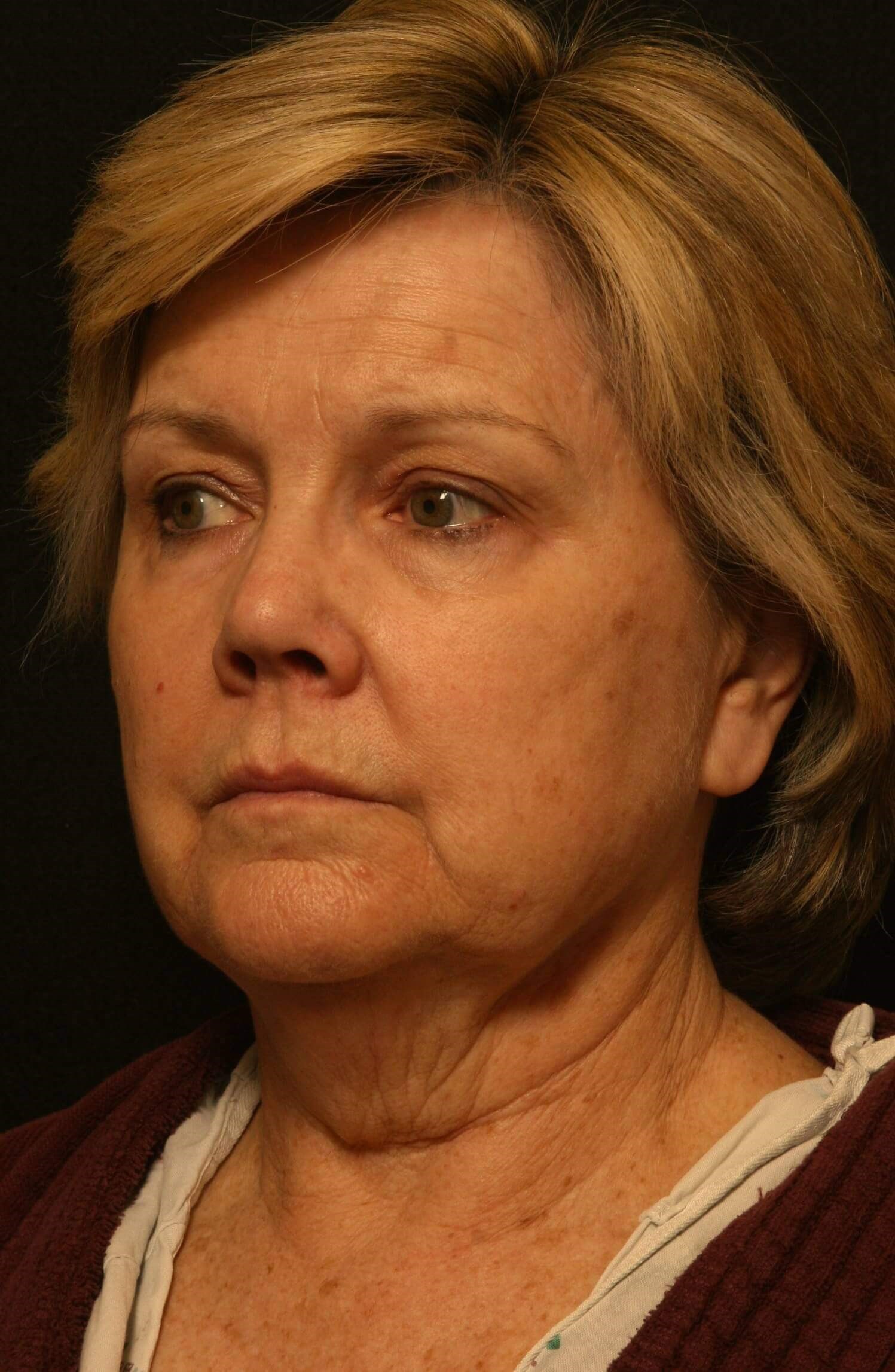 Facelift Before and After Before