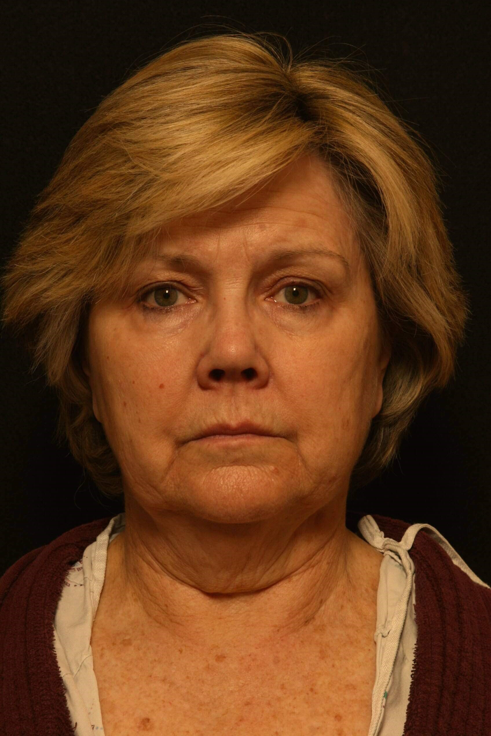 Facelift Before and After Before