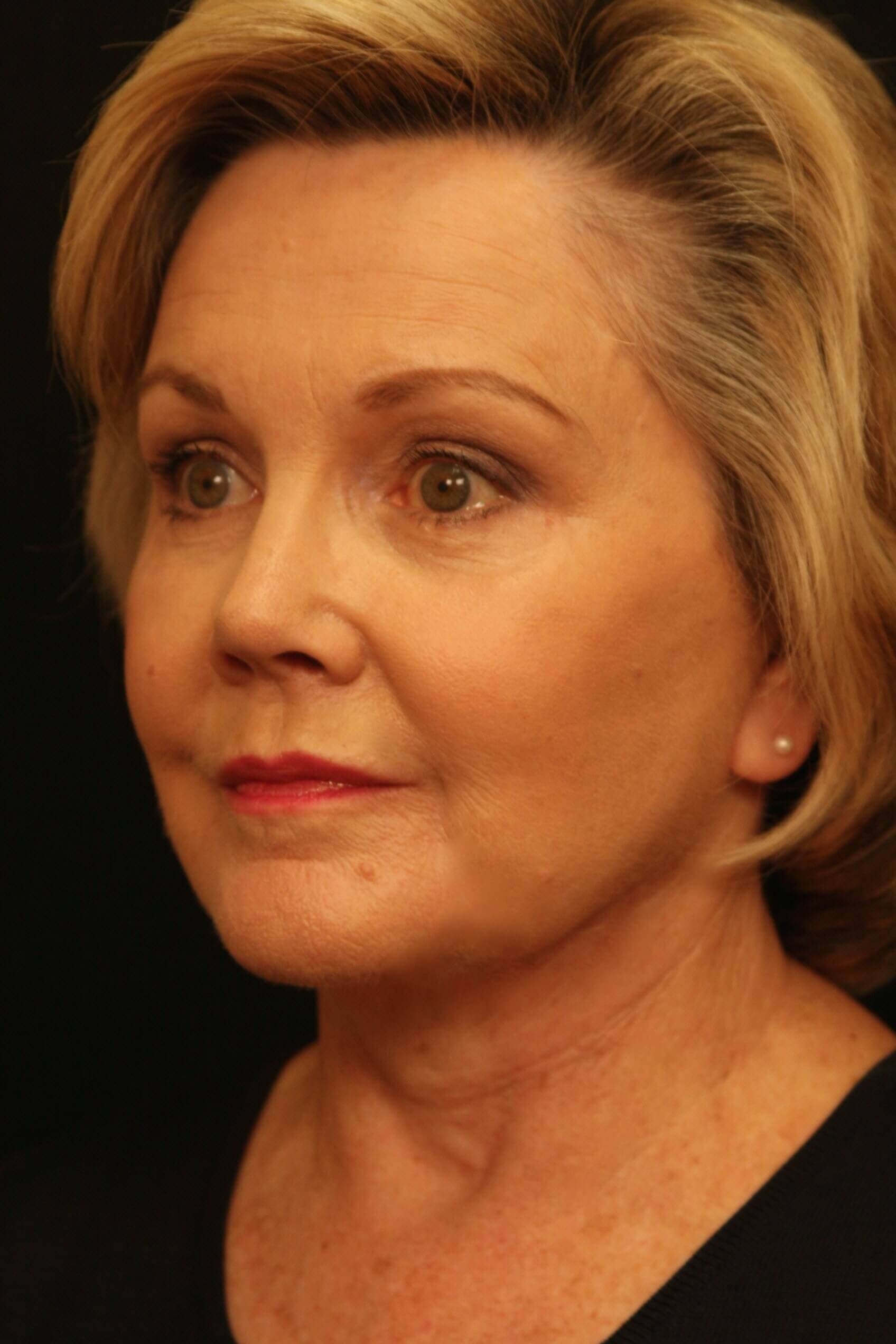 Facelift Before and After After