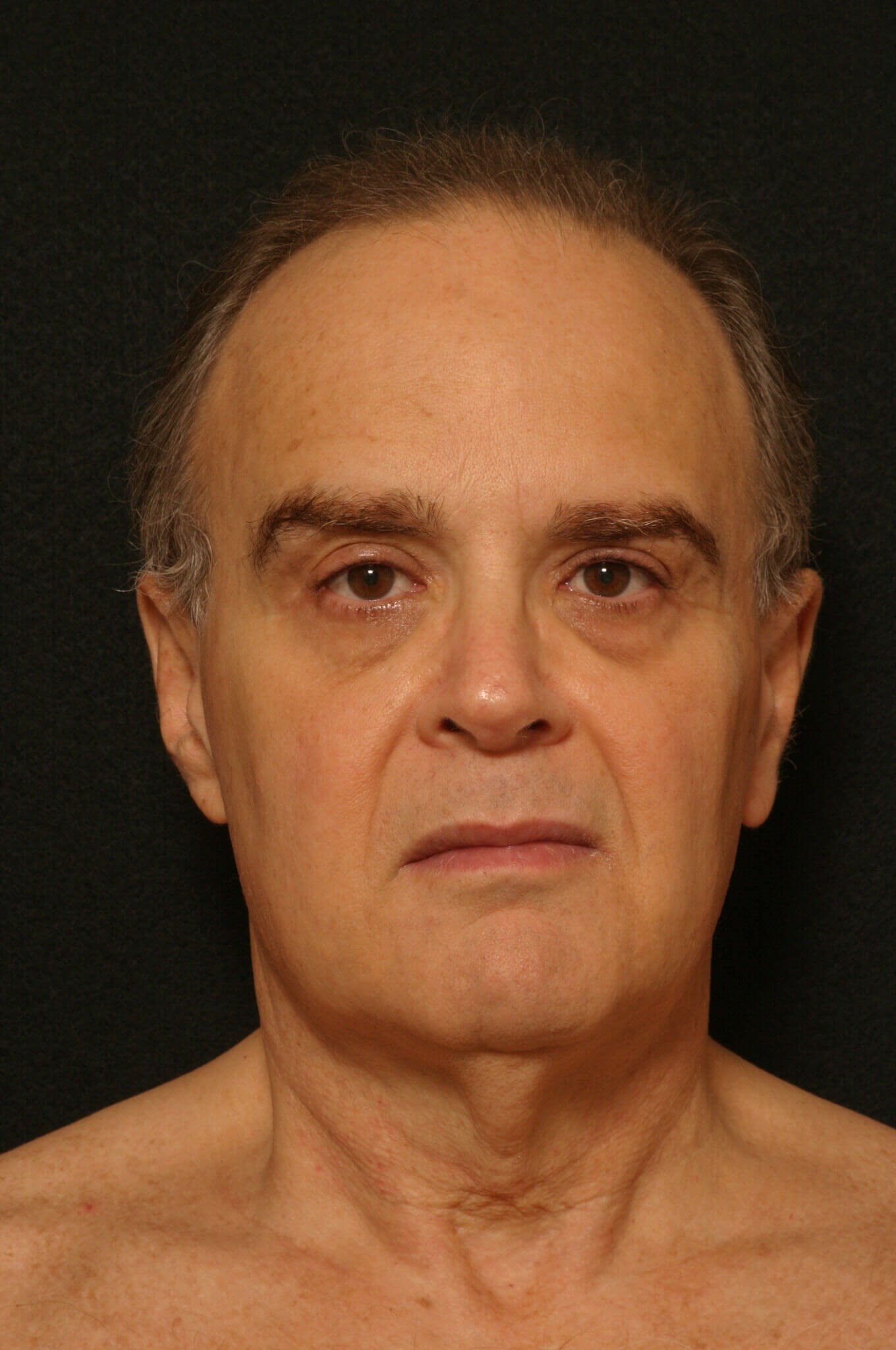 Facelift Before and After Before