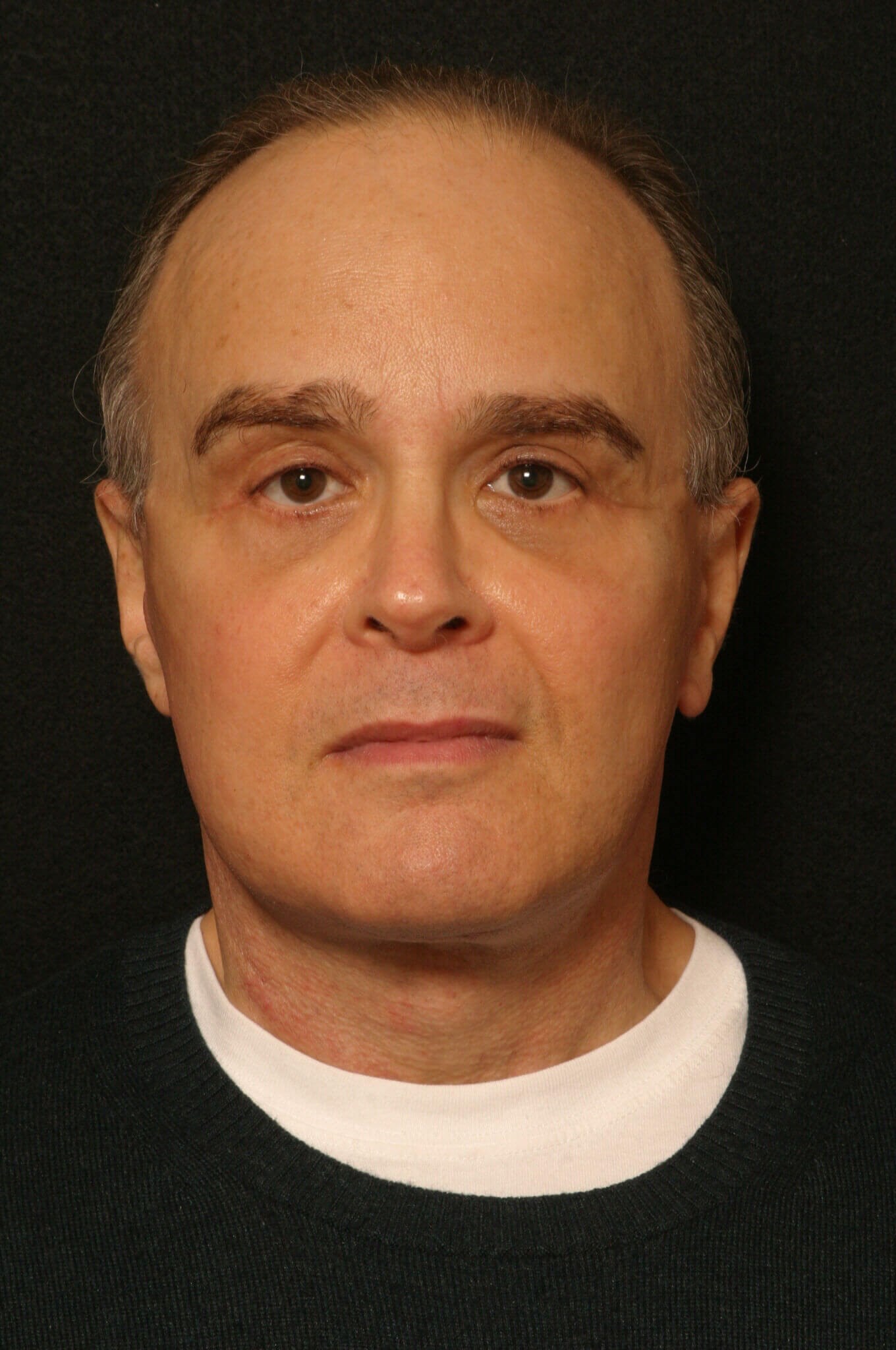 Facelift Before and After After