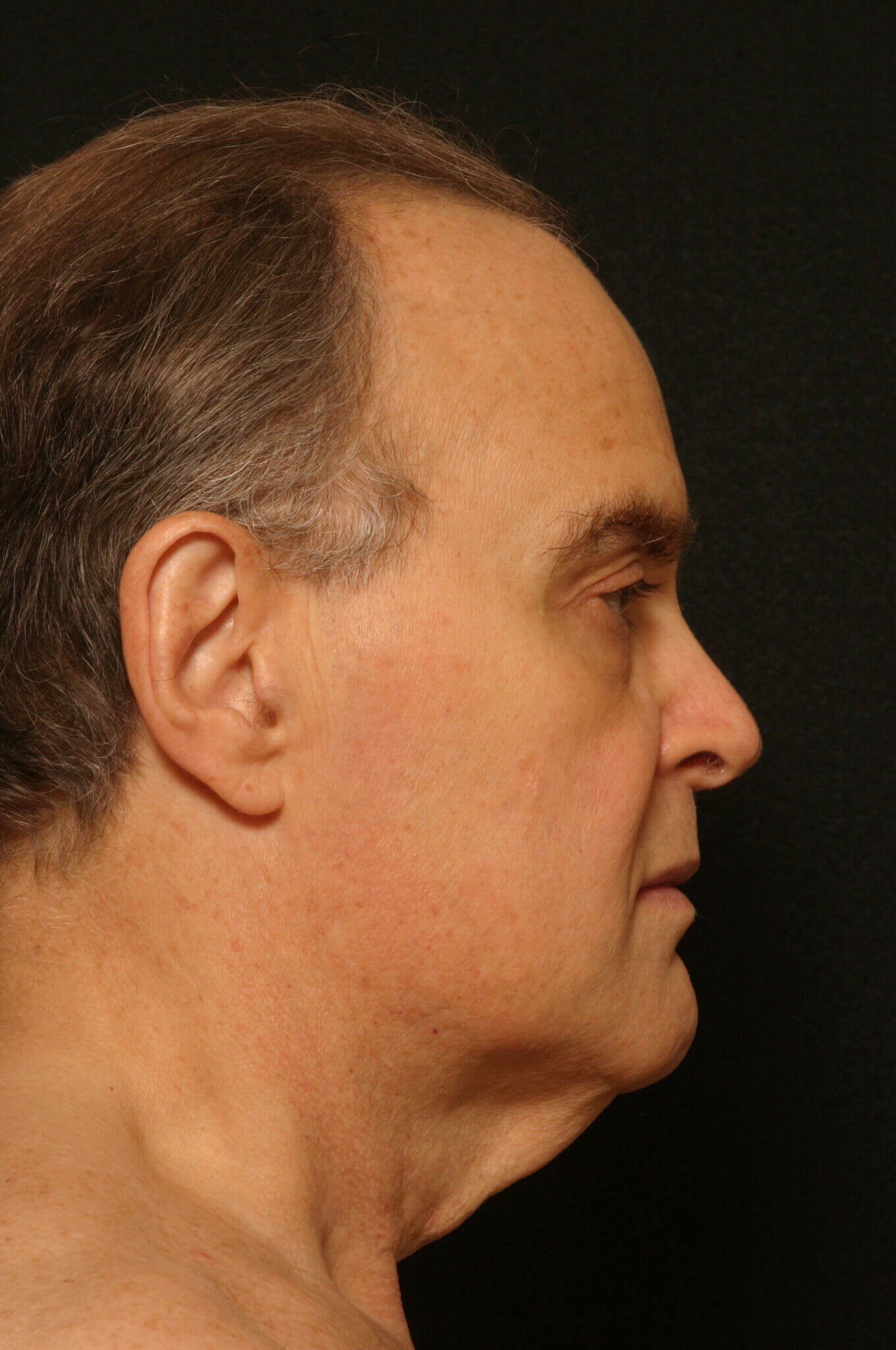 Facelift Before and After Before